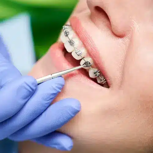 Teeth braces cost in Ahmedabad with affordable orthodontic treatment at Dr. Teeth Radhe Dental Clinic