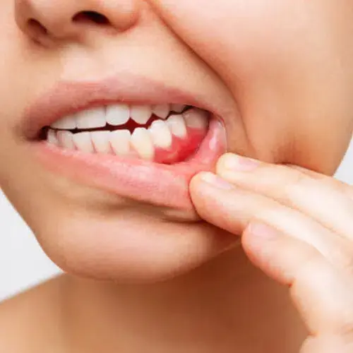 Pyorrhea treatment for bleeding gums and advanced gum disease care