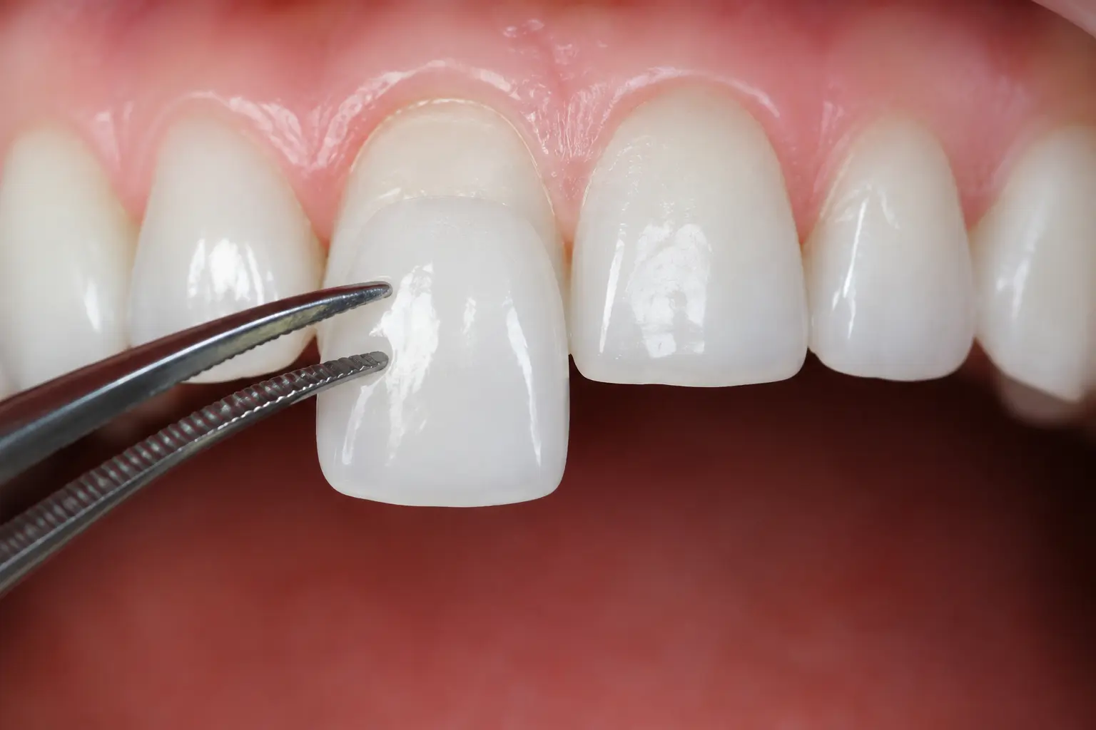 Teeth cap treatment in Ahmedabad